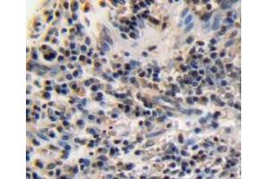 IHC-P analysis of esophagus cancer tissue, with DAB staining. (Ki-67 抗体  (AA 3088-3235))
