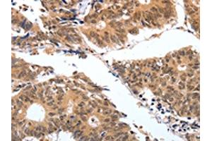 The image on the left is immunohistochemistry of paraffin-embedded Human colon cancer tissue using ABIN7130598(PGC Antibody) at dilution 1/25, on the right is treated with fusion protein. (PGC 抗体)