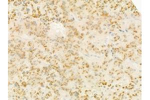 ABIN6264276 and ABIN6279342 at 1/100 staining human hepatocellular carcinoma by IHC-P. (PLA2G4F 抗体  (C-Term))