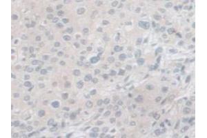 IHC-P analysis of Human Prostate Gland Cancer Tissue, with DAB staining. (PCSK1 抗体  (AA 500-738))