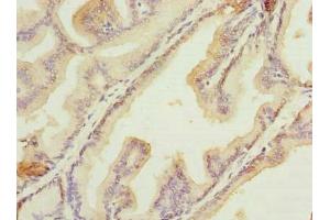 Immunohistochemistry of paraffin-embedded human prostate cancer using ABIN7156012 at dilution of 1:100 (HSDL2 抗体  (AA 1-345))