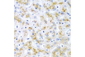 Immunohistochemistry of paraffin-embedded human liver damage using WNT2 antibody (ABIN6130801, ABIN6150239, ABIN6150241 and ABIN6221571) at dilution of 1:200 (40x lens). (WNT2 抗体  (AA 26-360))