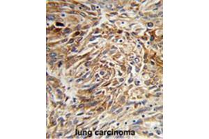 Formalin-fixed and paraffin-embedded human lung carcinoma reacted with AGR3 Antibody (C-term), which was peroxidase-conjugated to the secondary antibody, followed by DAB staining.