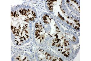 Anti-p107 antibody, IHC(P) IHC(P): Human Intestinal Cancer Tissue (p107 抗体  (C-Term))