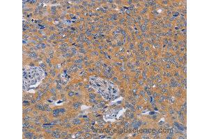 Immunohistochemistry of Human thyroid cancer using BOD1 Polyclonal Antibody at dilution of 1:60 (BOD1 抗体)