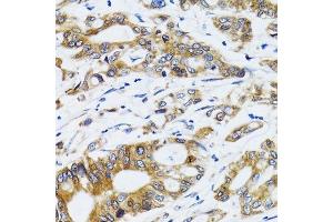 Immunohistochemistry of paraffin-embedded human colon carcinoma using PGRMC1 antibody. (PGRMC1 抗体  (AA 44-195))