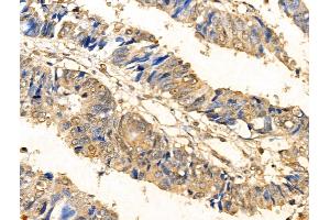 ABIN6261864 and ABIN6266543 at 1/100 staining Human colorectal cancer by IHC-P.