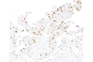 Immunohistochemistry (IHC) image for anti-Forkhead Box M1 (FOXM1) (AA 650-700) antibody (ABIN7795806) (Recombinant FOXM1 抗体  (AA 650-700))