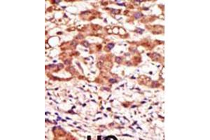 Formalin-fixed and paraffin-embedded human cancer tissue reacted with the primary antibody, which was peroxidase-conjugated to the secondary antibody, followed by AEC staining. (MGAT1 抗体  (N-Term))