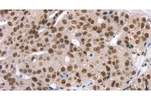 Immunohistochemistry of paraffin-embedded Human breast cancer using TAF15 Polyclonal Antibody at dilution of 1:35