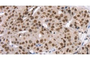 Immunohistochemistry of paraffin-embedded Human breast cancer using TAF15 Polyclonal Antibody at dilution of 1:35 (TAF15 抗体)