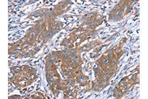 The image on the left is immunohistochemistry of paraffin-embedded Human cervical cancer tissue using ABIN7130635(PITPNM1 Antibody) at dilution 1/40, on the right is treated with fusion protein. (PITPNM1 抗体)
