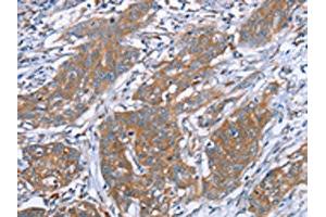 The image on the left is immunohistochemistry of paraffin-embedded Human cervical cancer tissue using ABIN7130635(PITPNM1 Antibody) at dilution 1/40, on the right is treated with fusion protein.