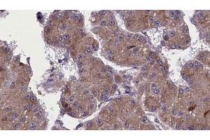 ABIN6272758 at 1/100 staining Human liver cancer tissue by IHC-P. (OR52H1 抗体)