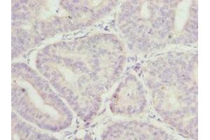 Immunohistochemistry of paraffin-embedded human endometrial cancer using ABIN7158931 at dilution of 1:100 (MR1 抗体  (AA 20-260))