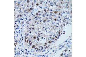 Immunohistochemistry of paraffin-embedded human lung cancer using UHRF1 antibody. (UHRF1 抗体)