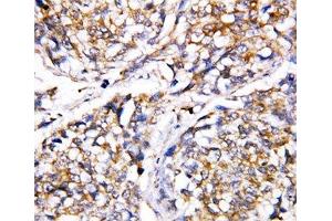 IHC-P: Caspase-4 antibody testing of human breast cancer tissue (Caspase 4 抗体  (AA 104-124))