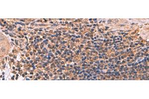 Immunohistochemistry of paraffin-embedded Human cervical cancer tissue using ZBTB33 Polyclonal Antibody at dilution of 1:30(x200) (ZBTB33 抗体)