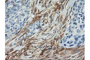 Immunohistochemical staining of paraffin-embedded Adenocarcinoma of Human breast tissue using anti-CNN2 mouse monoclonal antibody. (CNN2 抗体)