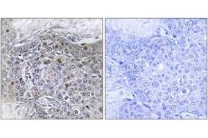 Immunohistochemistry analysis of paraffin-embedded human breast carcinoma tissue, using ZMY11 Antibody. (ZMYND11 抗体  (AA 111-160))