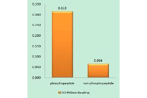 Immunohistochemistry analysis of paraffin-embedded human breast carcinoma tissue using Girdin (Phospho-Ser1417) antibody. (Girdin 抗体  (pSer1417))