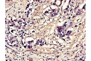 Immunohistochemistry of paraffin-embedded human gastric cancer using ABIN7152114 at dilution of 1:100 (EIF4A3 抗体  (AA 6-166))