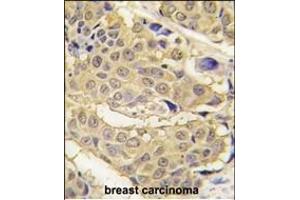 Formalin-fixed and paraffin-embedded human breast carcinoma tissue reacted with EPRS antibody (N-term) (ABIN391816 and ABIN2841664) , which was peroxidase-conjugated to the secondary antibody, followed by DAB staining. (EPRS 抗体  (N-Term))