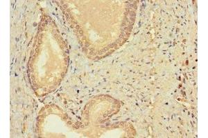 Immunohistochemistry of paraffin-embedded human prostate cancer using ABIN7147459 at dilution of 1:100 (CERKL 抗体  (AA 1-558))