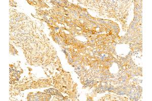 FAM92A1 Antibody at 1/100 staining Human lung cancer by IHC-P. (FAM92A1 抗体  (C-Term))