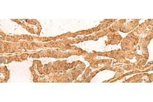 Immunohistochemistry of paraffin-embedded Human thyroid cancer tissue using ZBTB8A Polyclonal Antibody at dilution of 1:100(x200) (ZBTB8A 抗体)