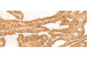 Immunohistochemistry of paraffin-embedded Human thyroid cancer tissue using ZBTB8A Polyclonal Antibody at dilution of 1:100(x200)