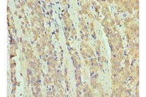 Immunohistochemistry of paraffin-embedded human colon cancer using ABIN7171070 at dilution of 1:100 (SMARCB1 抗体  (AA 86-385))