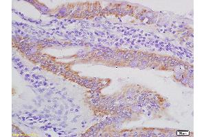Formalin-fixed and paraffin embedded human colon carcinoma labeled with Rabbit Anti AXL/UFO Polyclonal Antibody, Unconjugated (ABIN756022) at 1:200 followed by conjugation to the secondary antibody and DAB staining (AXL 抗体  (AA 151-250))