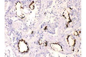 Anterior Gradient 2 was detected in paraffin-embedded sections of  human lung cancer tissues using rabbit anti- Anterior Gradient 2 Antigen Affinity purified polyclonal antibody (Catalog # ) at 1 µg/mL. (AGR2 抗体  (AA 21-175))