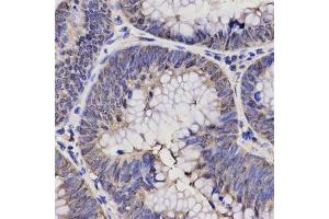 Immunohistochemistry of paraffin-embedded human rectal cancer using NPPA antibody at dilution of 1:200 (x400 lens). (NPPA 抗体)