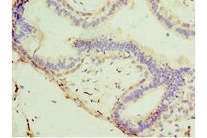 Immunohistochemistry of paraffin-embedded human breast cancer using ABIN7171226 at dilution of 1:100 (Syntaxin 11 抗体  (AA 1-287))
