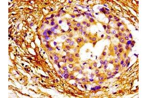 Immunohistochemistry of paraffin-embedded human breast cancer using ABIN7160388 at dilution of 1:100 (MAZ 抗体  (AA 30-80))