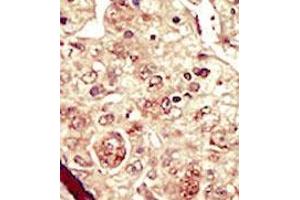 Formalin-fixed and paraffin-embedded human cancer tissue (hepatocarcinoma) reacted with the primary antibody, which was peroxidase-conjugated to the secondary antibody, followed by DAB staining. (STK16 抗体  (C-Term))