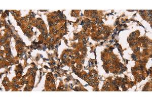 Immunohistochemistry of paraffin-embedded Human breast cancer tissue using ATRN Polyclonal Antibody at dilution 1:50 (Attractin 抗体)