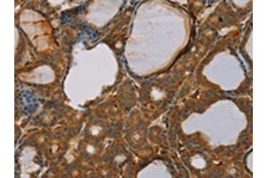 The image on the left is immunohistochemistry of paraffin-embedded Human thyroid cancer tissue using ABIN7130527(PAGE2 Antibody) at dilution 1/20, on the right is treated with fusion protein. (PAGE2 抗体)