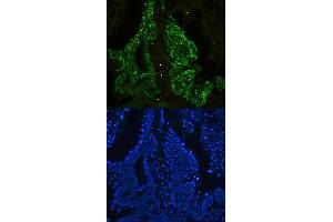 IF analysis of CTBP2 using anti-CTBP2 antibody (ABIN3042768) CTBP2 was detected in paraffin-embedded section of human colon cancer tissues. (CTBP2 抗体  (AA 321-445))