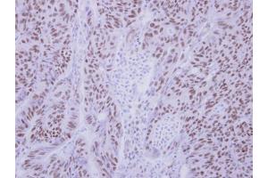IHC-P Image Immunohistochemical analysis of paraffin-embedded human colon carcinoma, using BS69 antibody, antibody at 1:250 dilution. (ZMYND11 抗体)