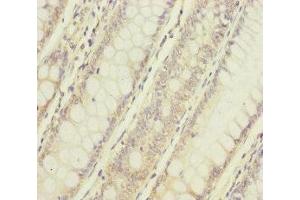 Immunohistochemistry of paraffin-embedded human colon cancer using ABIN7160738 at dilution of 1:100 (NAA25 抗体  (AA 703-972))