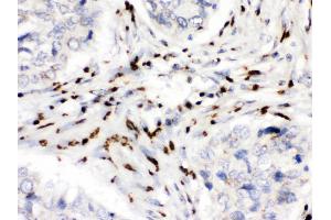 MDMX was detected in paraffin-embedded sections of human lung cancer tissues using rabbit anti- MDMX Antigen Affinity purified polyclonal antibody at 1 μg/mL. (MDM4-binding Protein 抗体  (N-Term))