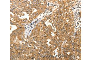 Immunohistochemistry of Human lung cancer using MAP1B  Polyclonal Antibody at dilution of 1:40 (MAP1B 抗体)