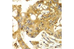Immunohistochemistry of paraffin-embedded human liver cancer using CAPNS1 antibody. (Calpain S1 抗体  (AA 69-268))