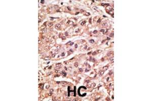 Immunohistochemistry (IHC) image for anti-Small Ubiquitin Related Modifier 4 (SUMO4) (Met55Val-Mutant) antibody (ABIN2996873) (SUMO4 抗体  (Met55Val-Mutant))