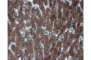 Immunohistochemical staining of paraffin-embedded Adenocarcinoma of endometrium tissue using anti-FAHD2A mouse monoclonal antibody. (FAHD2A 抗体)