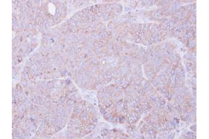 IHC-P Image Immunohistochemical analysis of paraffin-embedded SW480 xenograft, using RAGE, antibody at 1:100 dilution. (MOK 抗体)