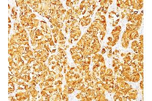 Formalin-fixed, paraffin-embedded human Melanoma stained with Melan-A / MART-1 Mouse Monoclonal Antibody (DT101 + BC199). (MLANA 抗体)